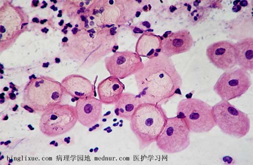 外阴鳞状上皮细胞增生|活检显示鳞状细胞增生是癌前病变吗？